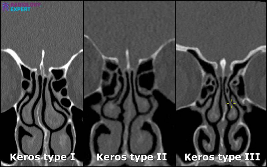 CT Sinus CT Sinus